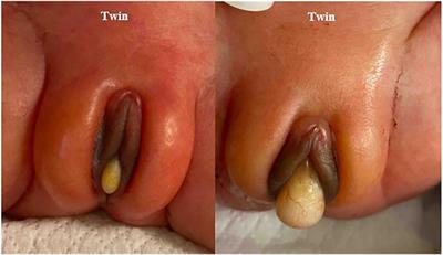 Familial occurrence of imperforate hymen in premature monozygotic twins and their mother: a case report and literature review